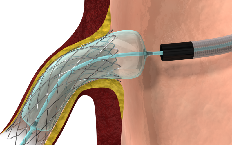 Stent Deployment using the Ostial Pro HD | Trinsic Animation Stent Deployment using the Ostial Pro HD | Trinsic Animation